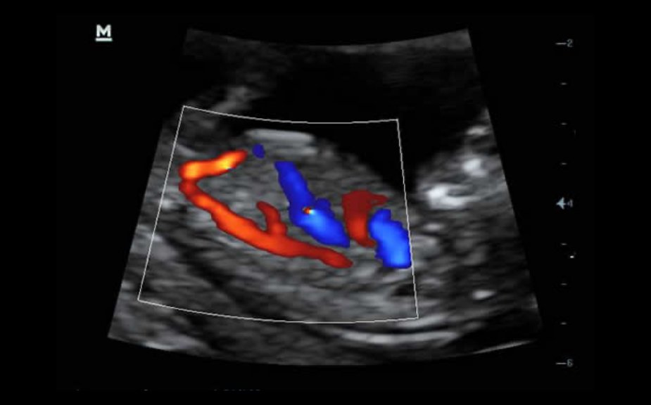 Fetal Aortic Arch
