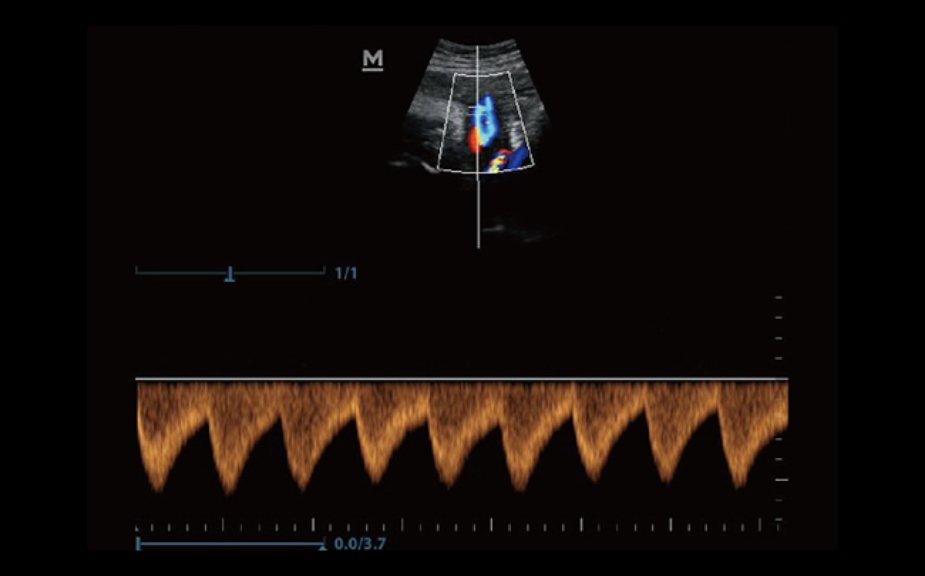 PW of Umbilical Artery