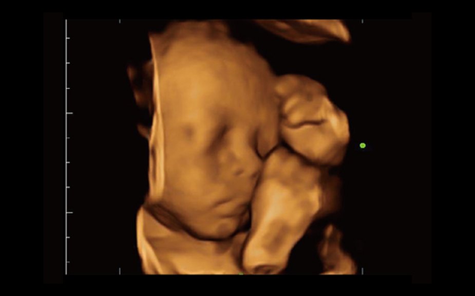 3D of Fetal Face