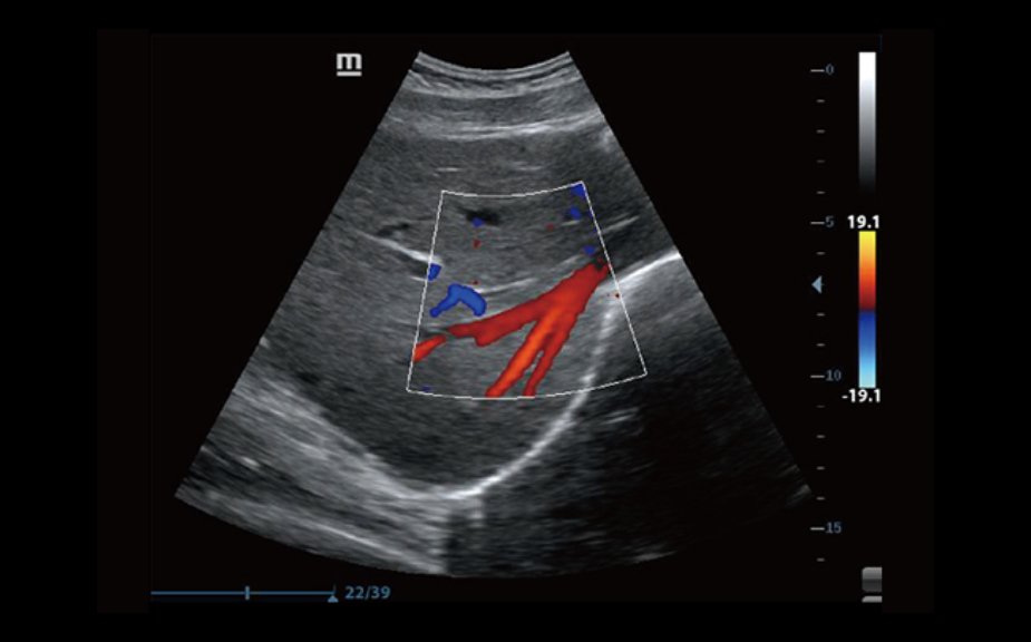 Color Flow of Liver