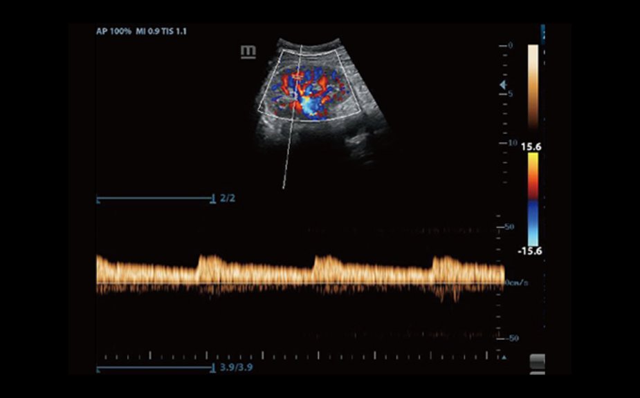 PW of Renal Artery