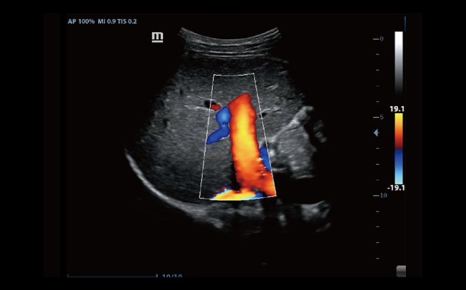 Color Flow of Portal Vein