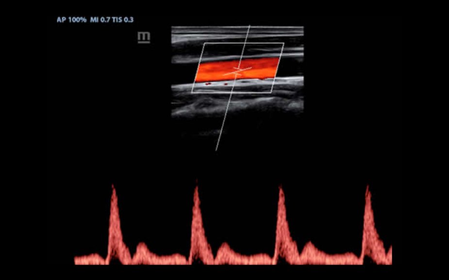 PW of Carotid